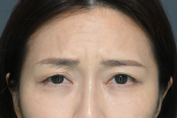 療程前：皺眉｜案例分享：Jaly